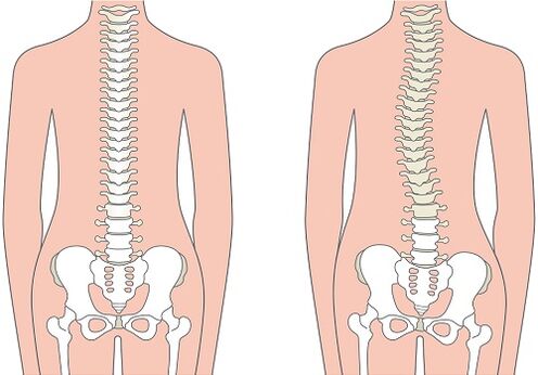 Back pain due to spinal deformities such as scoliosis