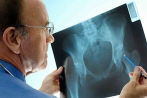 Arthrosis of the hip joint on x -ray