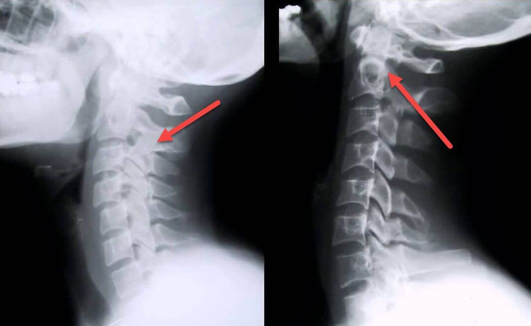 Manifestations of cervical spine osteochondrosis on x-ray