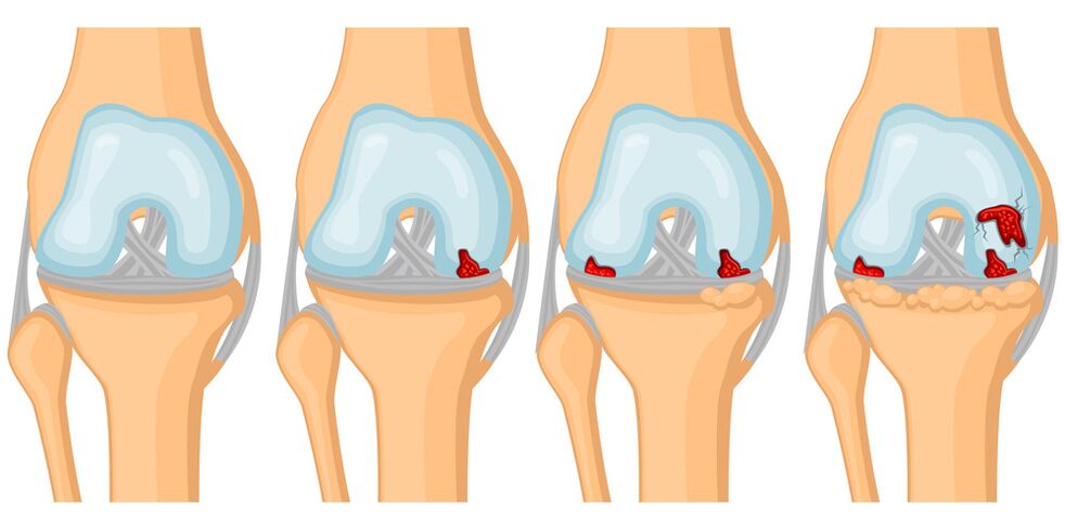 Stages of development of joint arthrosis