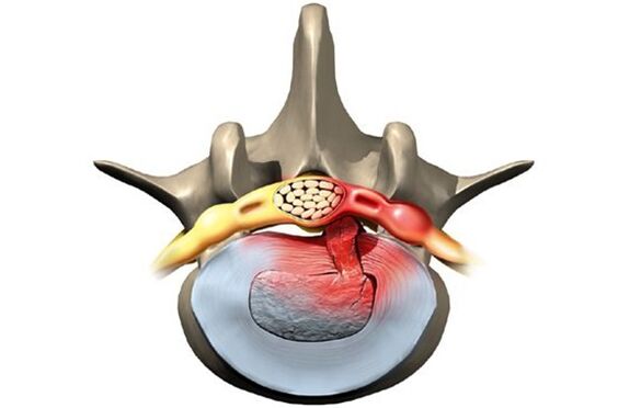 vertebrae affected by osteochondrosis